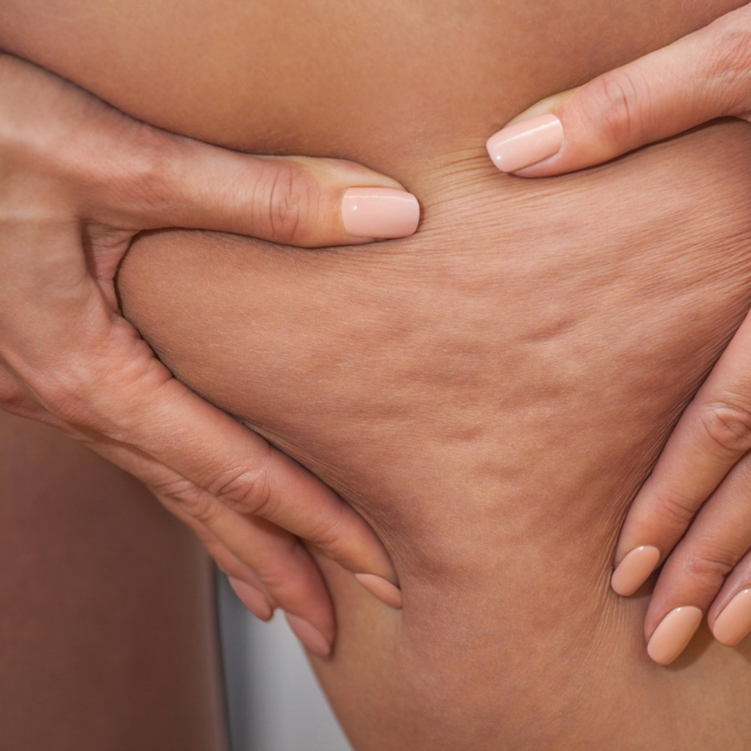 Decoding Cellulite